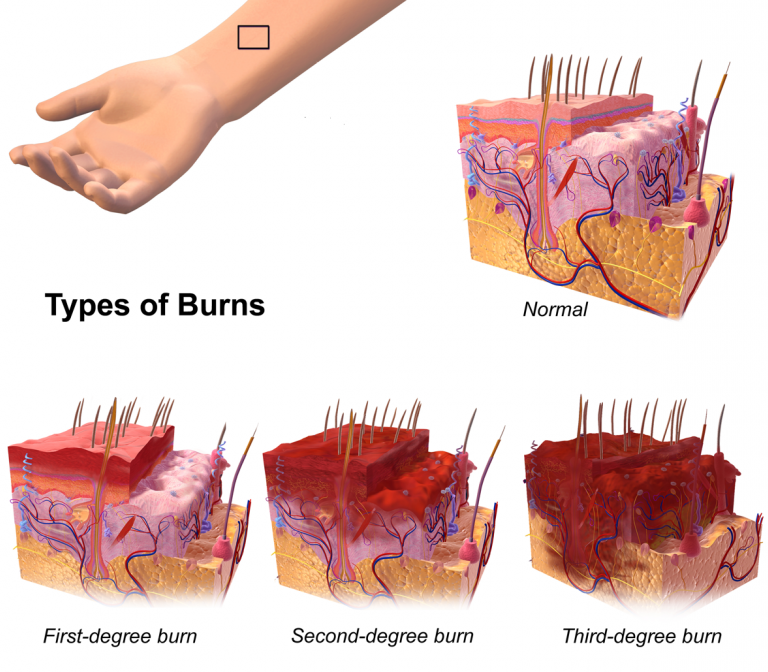Ultrasonography to assess muscle loss in patients with major burns