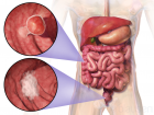 Proteins may improve screening for colorectal cancer 