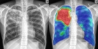 Van röntgenfoto naar snelle diagnose: hoe AI Tuberculose wereldwijd helpt bestrijden 