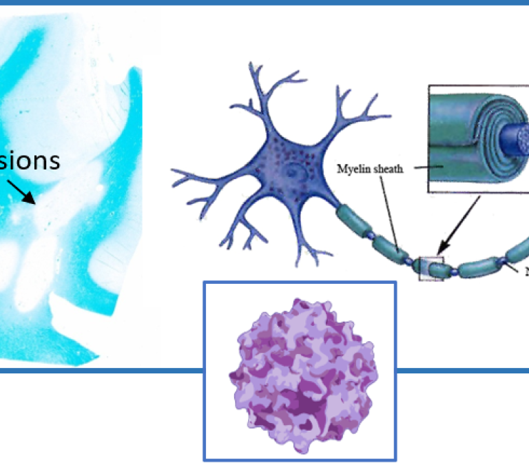 Development of a Non-Invasive Gene Therapy for Multiple Sclerosis