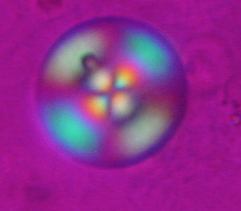 Human Crystal Diagnostics with hybrid Raman spectrograph and polarised light microscope