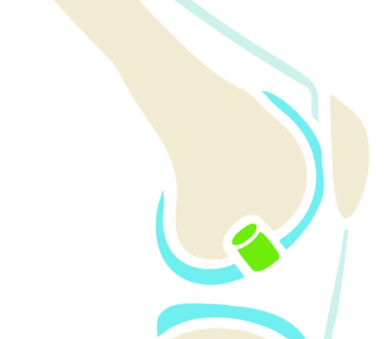 Donor bone-cartilage transplantations for knee joint preservation