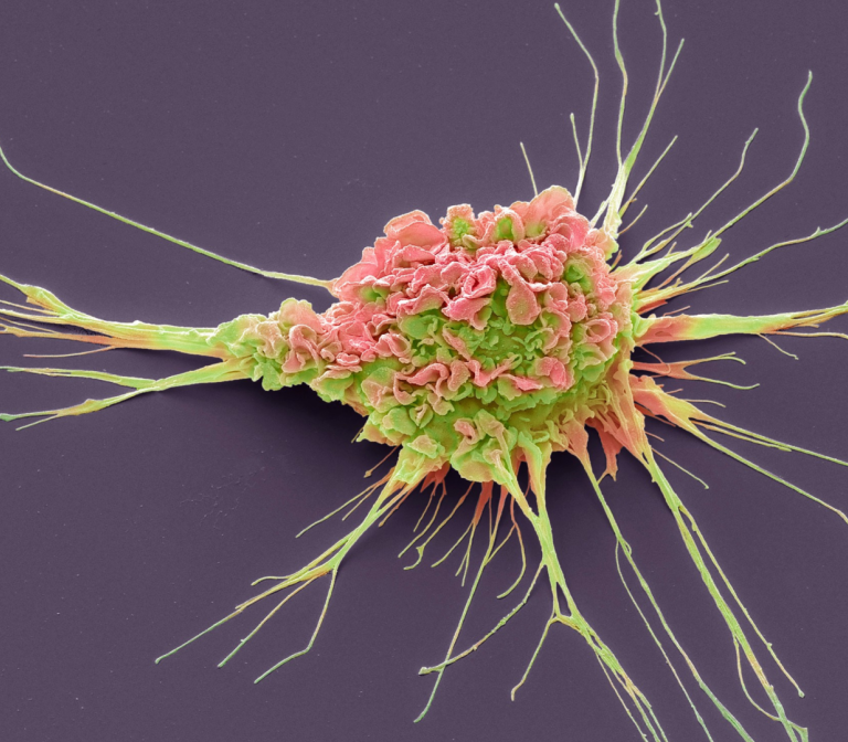The patient’s own cells as therapy for rheumatoid arthritis