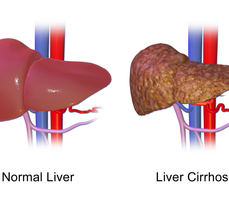 Characterisation of Biomarkers for Non-Alcoholic Steatohepatitis