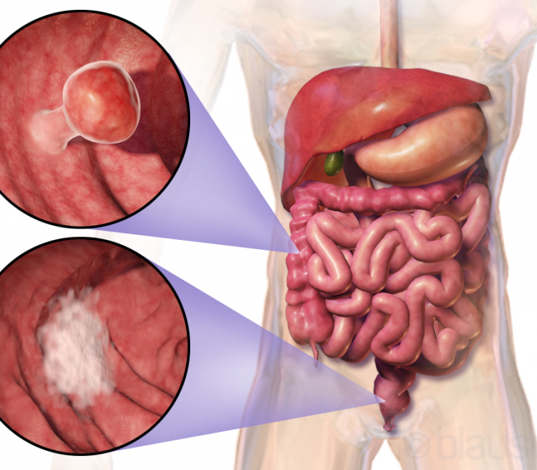 Development of a better molecular test for colorectal cancer screening  
