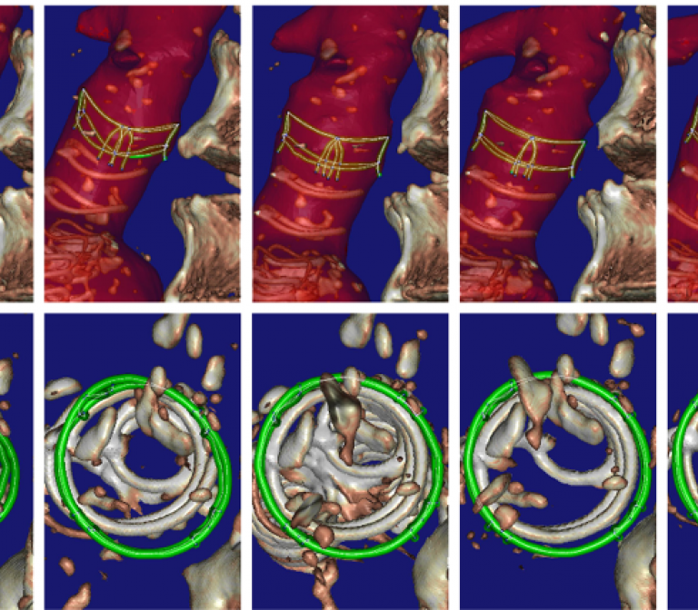 Improving endovascular treatment for aneurysm 