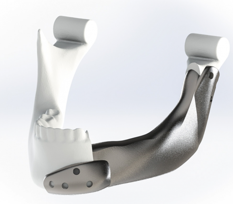 A novel 3D printed titanium jaw implant after partial lower jaw resection
