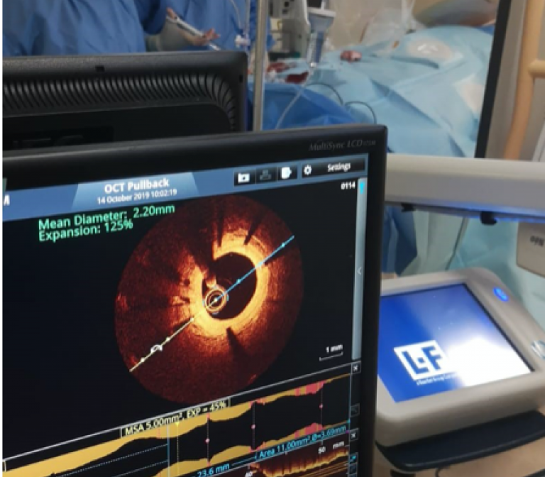 Identifying high risk coronary lesions using Optical Coherence Tomography